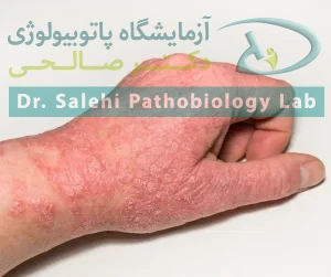  تفاوت بین اگزما و قارچ چیست؟