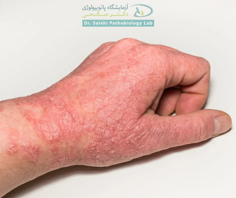  تفاوت بین اگزما و قارچ چیست؟